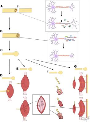 Target Receptors of Regenerating Nerves: Neuroma Formation and Current Treatment Options